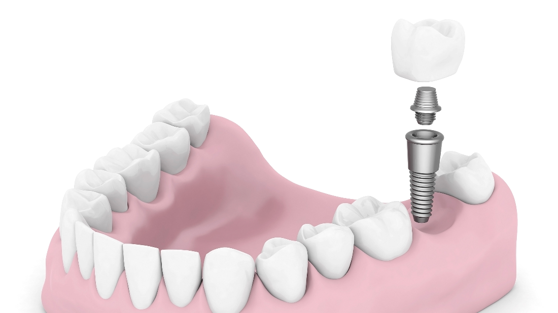 South Chico Dental Care Blog Caring for Dental Implants Chico CA