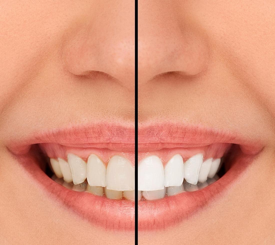 Dr Dan Surh DMD Blog Is Teeth Whitening in Chico Worth It?