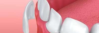 A picture of veneers in South Chico Dental Care, CA