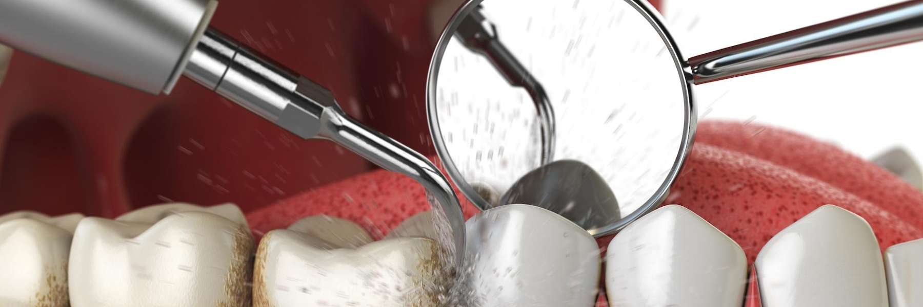 Dental clean up at South Chico Dental Care, Chico,CA