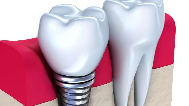 An illustration of dental implant in Chico, CA.