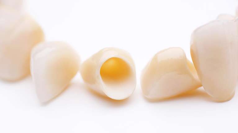 A picture of Dental crowns in South Chico CA