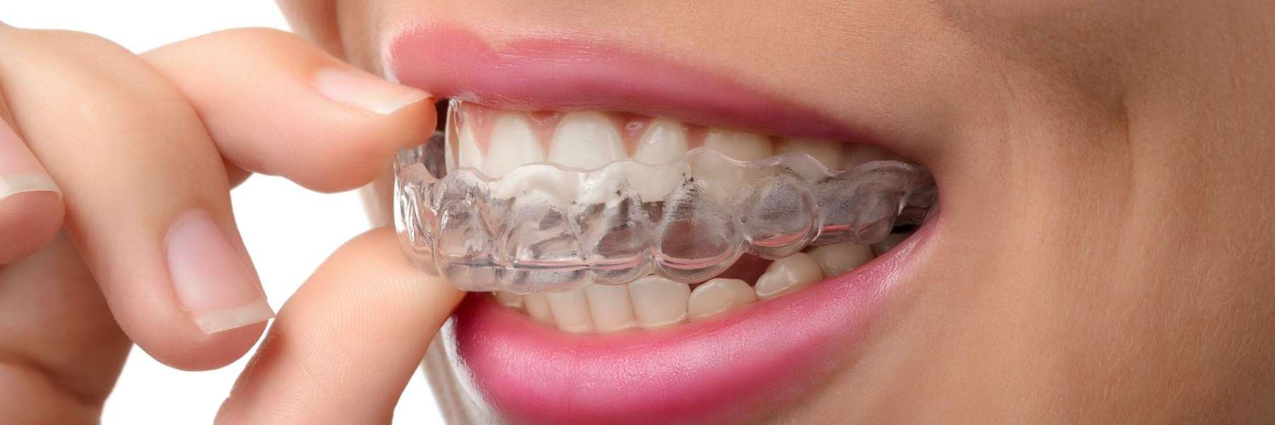 A patient holding clear braces in South Chico. Chico, CA
