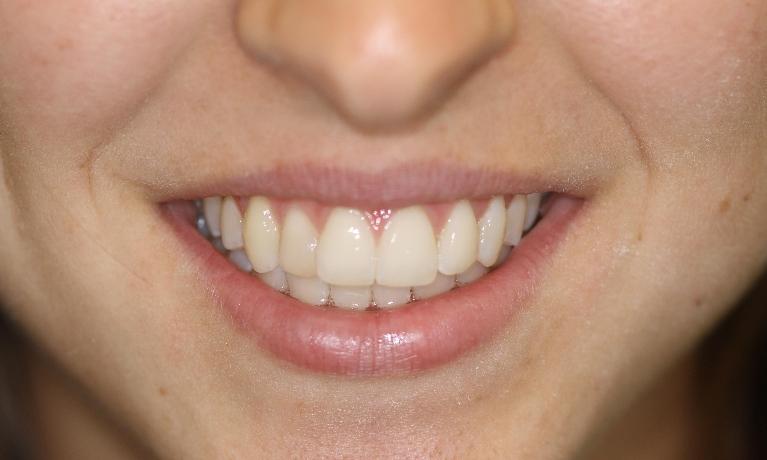 After treatment - Six Month Smiles Case