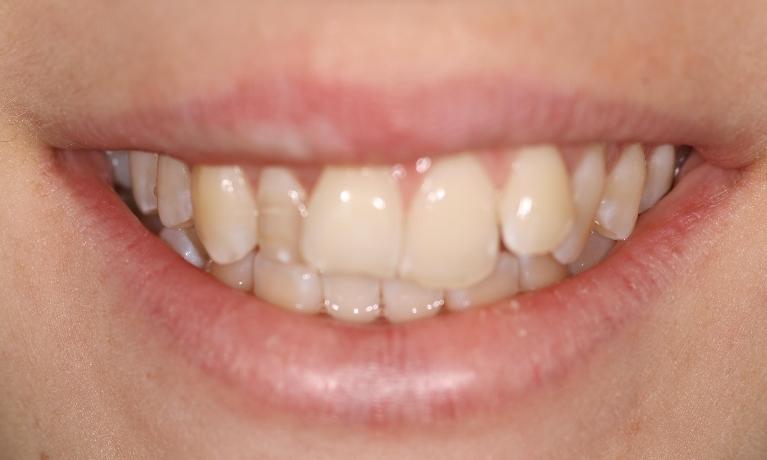 Before treatment - Six Month Smiles Case